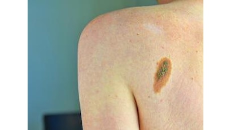 Tumori, +30% diagnosi melanoma in 2024, mai così tanti