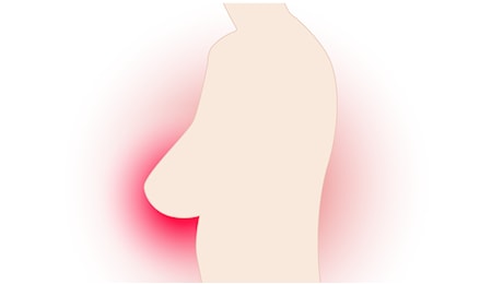 Noduli al seno: come riconoscerli (e quando sono pericolosi)