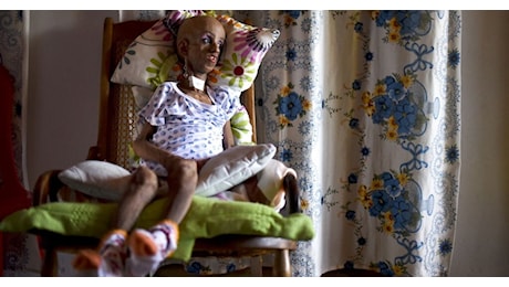 Cos'è la progeria di Hutchinson-Gilford, la malattia di Sammy Basso